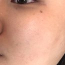 바이오2호태양광 | 상동 여드름관리 뷰티포톤피아 바이오필, 모공/색소 고민으로 받아본 후기