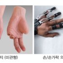 동성 보조기 네이버블로그