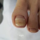 (주)아이솔루션 | [르사덤솔루션] 문제성 손발톱 케어 실제 사용 후기