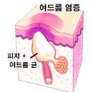 여드름, 박테리아(여드름균)만 제거하면 될까요? 이미지