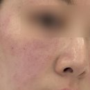 강서구 마곡 근처 피부과 추천! 리투오 스킨부스터 1주일 리얼 후기