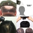 천안아산 SMP두피탈모커버스트레스받고 있다면