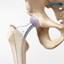 고관절 통증 원인과 치료법에 대해서 알아보자 이미지