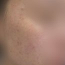 누가한의원 | 명동역 피부관리 추천 한의원 좁쌀 여드름 압출 침치료 내돈내산 후기