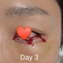 지만약국 | 30대 하안검 눈밑지 지방이식 스트레스 덜어내기 (약 2주간의 후기)