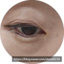 삼성연합의원 | [안동 안과 - 안동삼성연합안과의원] 콩다래끼를 제거했어요!!(재발)