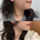 서울프라임병원 | 울쎄라피 프라임 300샷 후기 압구정피부과로 다녀왔어요 + 효과, 가격, 부작용 등