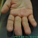 (주)청산식품 | 설거지 안 해도 생기는 '주부습진'? 진짜 정체는 '한포진'일 수 있습니다 (한포진 vs 습진 완벽 구별법)