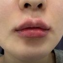 골드제이의원 | 입술필러 유명한 곳 리뷰 | 선릉역 골드제이의원 후기만 모음 | 가격, 진료시간, 예약, 붓기, 티타늄...