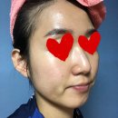 정림한의원 | 한 달 후 피부 상태 및 압출 직후 관리법/ 피지분비량에 따른 관리법