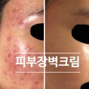 윤약국 | / 염증성 여드름 원인 없애준 꿀템 3가지 (올영, 약국, 추천템)
