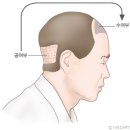 자가모발이식술[autologous hair transplantation] 이미지