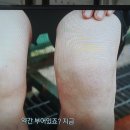 반월상 연골판 파열의 유형 이미지