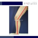 종아리 뒤쪽으로 혈관 돌출이 심한데, 허벅지 안쪽부터 수술이 시작되는 이유는? 이미지