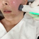 선릉역피부과 세르프 리프팅 300샷｜고주파 통증, 효과 솔직 후기
