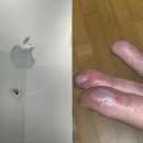 바지 속 아이폰의 배터리 폭발로 화상!…어찌 이런 일이 이미지