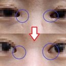 나영쌤 | 앞트임 흉터 레이저 치료 1회 후 경과 사진, 앞트임복원흉터 제거 후기, 피부과전문의 나영쌤