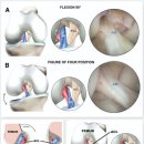 무릎 전방십자인대재건수술 정보 (수술법/자가건/타가건선택가이드/재활운동법) 이미지