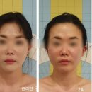 라라에스떼 | 부산윤곽관리 부산비대칭관리 추천 / 라라에스떼 윤곽관리 2회차 후기