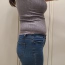 청라비만클리닉 복부 지방흡입, 골반 지이 전/후 변화후기