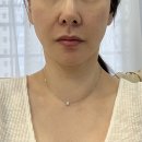 서울엘피부과의원 | 서울 강남역 온다리프팅 잘하는 피부과 포트라리프팅 싼곳 후기 가격 효과