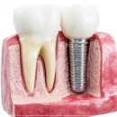에이플러스치과의원 | 은평구치과, 임플란트와 장기적인 구강 건강 알려드려요