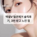 V-3 | 엑셀V 혈관제거 솔직후기, 3번 받고 느낀 점
