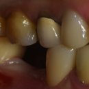 연세알막툼치과보철과치과의원 | 잇몸 욱신 통증 치과 브릿지 잇몸이 아파요 욱신거릴때, 보철 교체와 임플란트