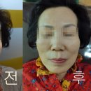 로이성형외과의원 | 강서구 피부과, 강서구 성형외과, 하이의원, 뉴테라 (HIFU) 리프팅 후기