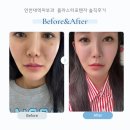 인천대입구역 2번출구 앞 | 인천대입구역피부과에서 콜라스터포텐자 맞고 모공, 탄력 다 잡은 송도스킨부스터후기