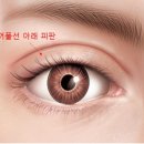 비아이오 성형외과 조인창 원장님 소세지 (큰쌍꺼풀) 상담후기