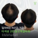 강동-천호-2476 | 강동 탈모 커버, 알고 나면 달라집니다