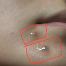 다뽑아 | 튀어나온 점 제거 사마귀 돌출점 피침요법 후기