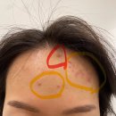 예일디자인고등학교 | 은평구 피부관리샵 이지뷰티랩에서 플라즈마로 수흉터관리 후기