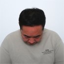 대해 | 포항두피문신 후기 부작용에대해