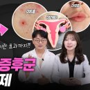 여드름, 생리불순, 다모증의 원인 ‘다낭성 난소 증후군’ 이거 하나면 됩니다 (다이어트, 임신 영양제) 이미지
