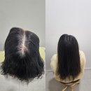 대구두피문신 리얼 후기-탈모 고민 끝에 결국 두피문신 선택