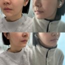 온리동물병원 | 동성로피부과ㅣ대구 콜라겐 주사 미희주사 팔자주름 볼륨 부스터 전후 비교