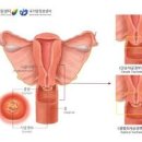 자궁경부암 조직검사 자궁경부암 자궁경부암 발생 방법 이미지