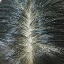 장담약국 | 니조랄 샴푸 약국 절대 하나만 쓰지 마요...!