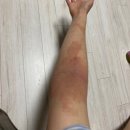 경희보라한의원 | 여름마다 괴롭히던 성인아토피 탈스테로이드 극복 과정