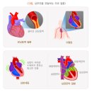 심부전heart failure , 心不全 이미지