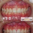 뻐드렁니교정 청소년 비발치교정 성수동치과 금호동치과 행당동치과 연세미소담은치과