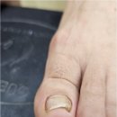 산호동152 | 마산 합성동 산호동 내성발톱 꼼꼼하고 효과좋은 네일팝 페디크루 내성발톱 무좀 문제성발 네일