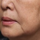 서강의원 | 신촌피부과 레디어스 스킨부스터 후기│마리오네트·눈가 주름 고민 수술 대신 선택한 방법