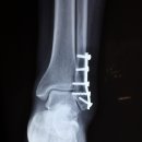 서현마디튼튼재활의학과의원 | 정형외과가 알려주는 계단 무릎 통증 완화 생활팁