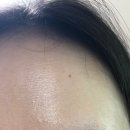 아이네오어린이집 | 수원역피부한의원 ㅣ 임산부 여드름 네오빔 케어 받아본 내돈내산 후기