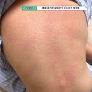 봄철 꽃가루 알레르기 비염 두드러기 n년차 대처법