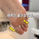 레푸스 - 광진구 능동로 400 | 울산굳은살 발각질 때문에 찾은 레푸스 울산삼산점 후기