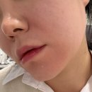 신논현역 | 쥬베룩 볼륨 슈링크 효과 좋았던 신논현역 피부과 후기 및 가격